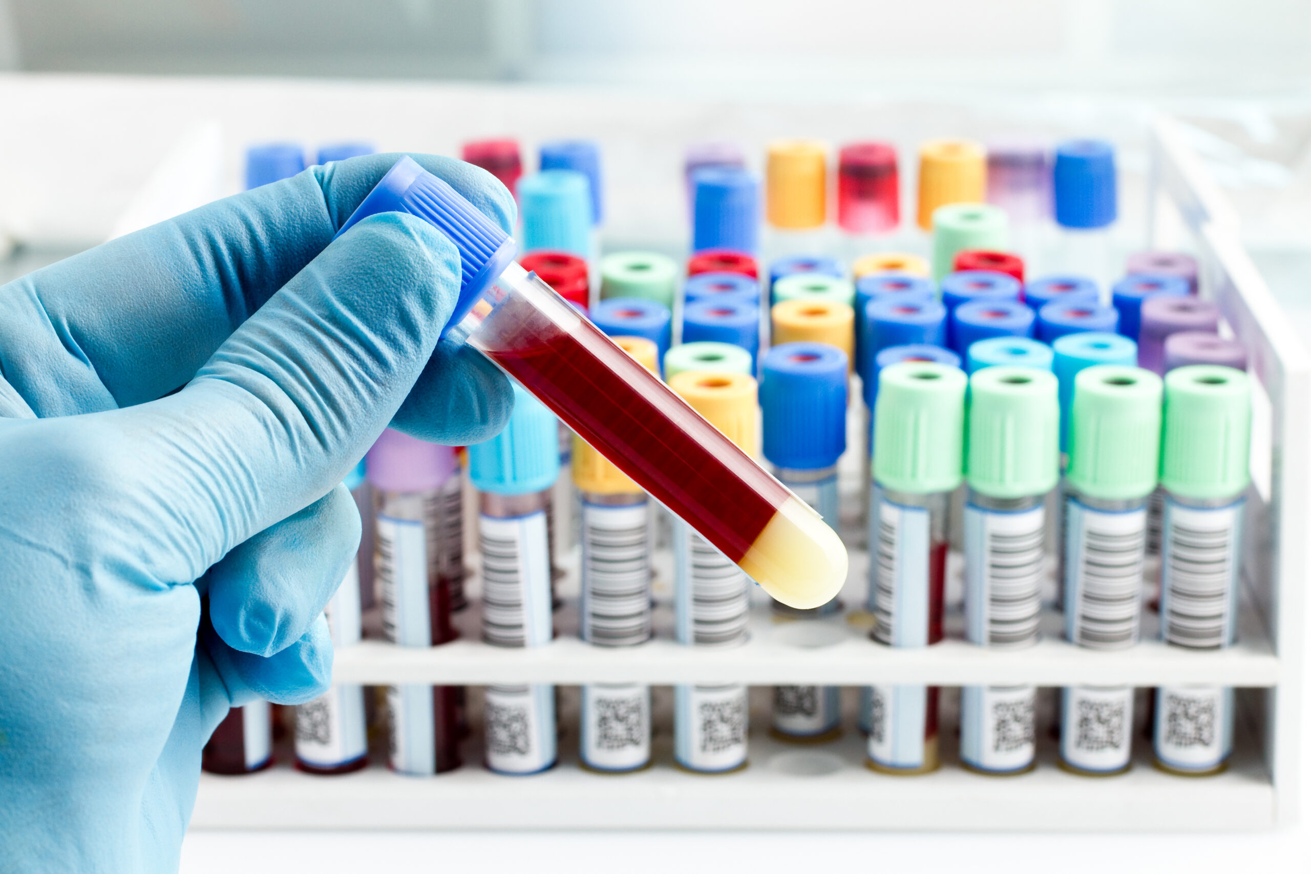 laboratory technician holding a blood tube test